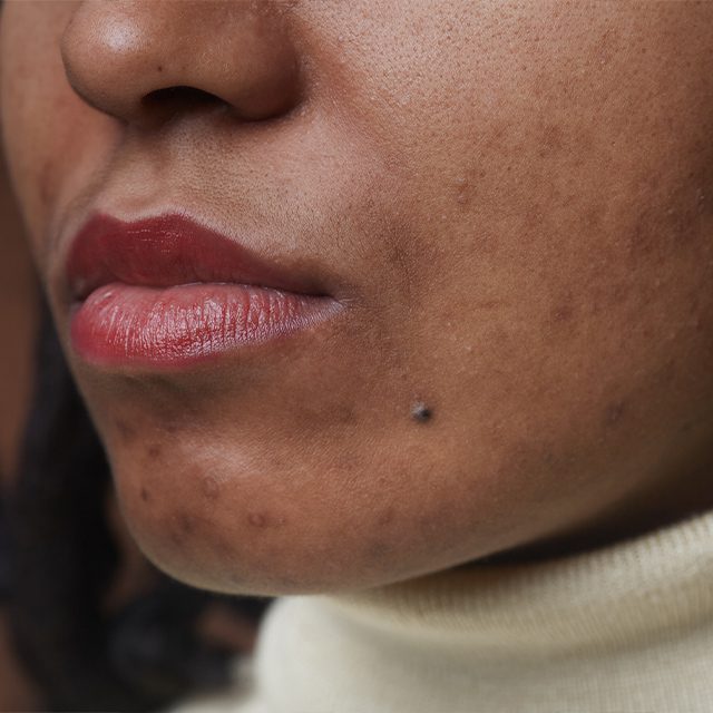 woman suffering from acne on her chin