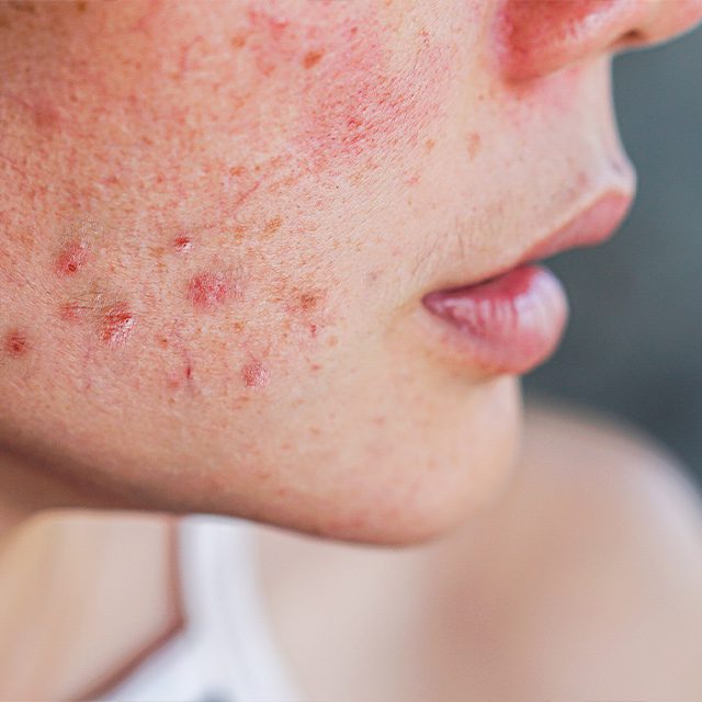 woman with acne on her cheek